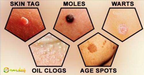 How To Remove Moles, Skin Tags, Warts, Spots And Blackheads, Easily and Naturally