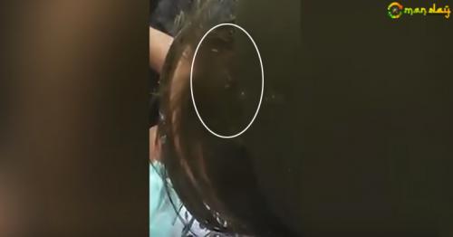 Watch: Shockingly severe lice infestation video goes viral and disgusts viewers worldwide